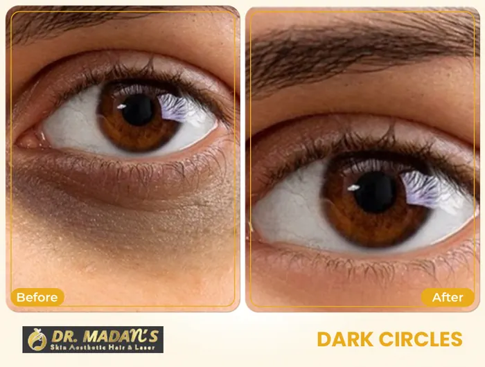 Dark circles before and after result 3 at Dr Madan Aesthetics